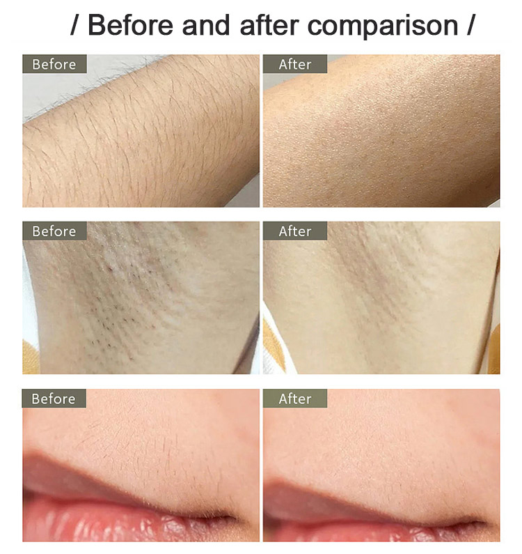hot hair removal machine