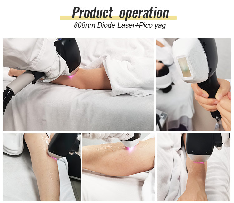 laser tattoo removal machine detail