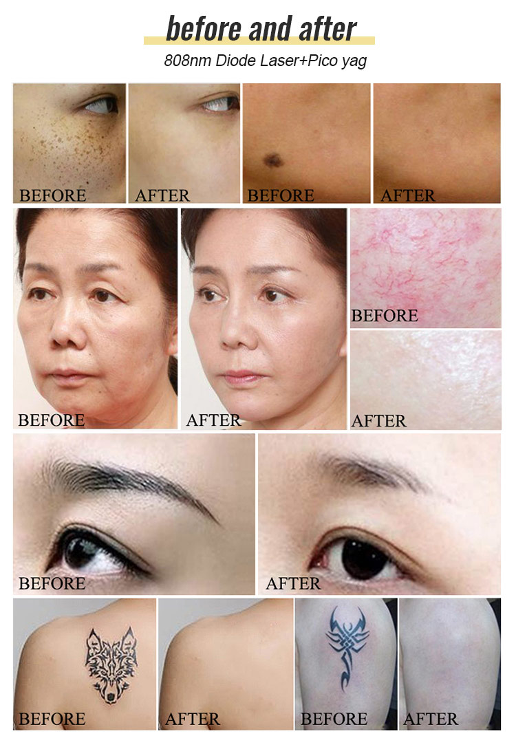 laser tattoo removal machine detail