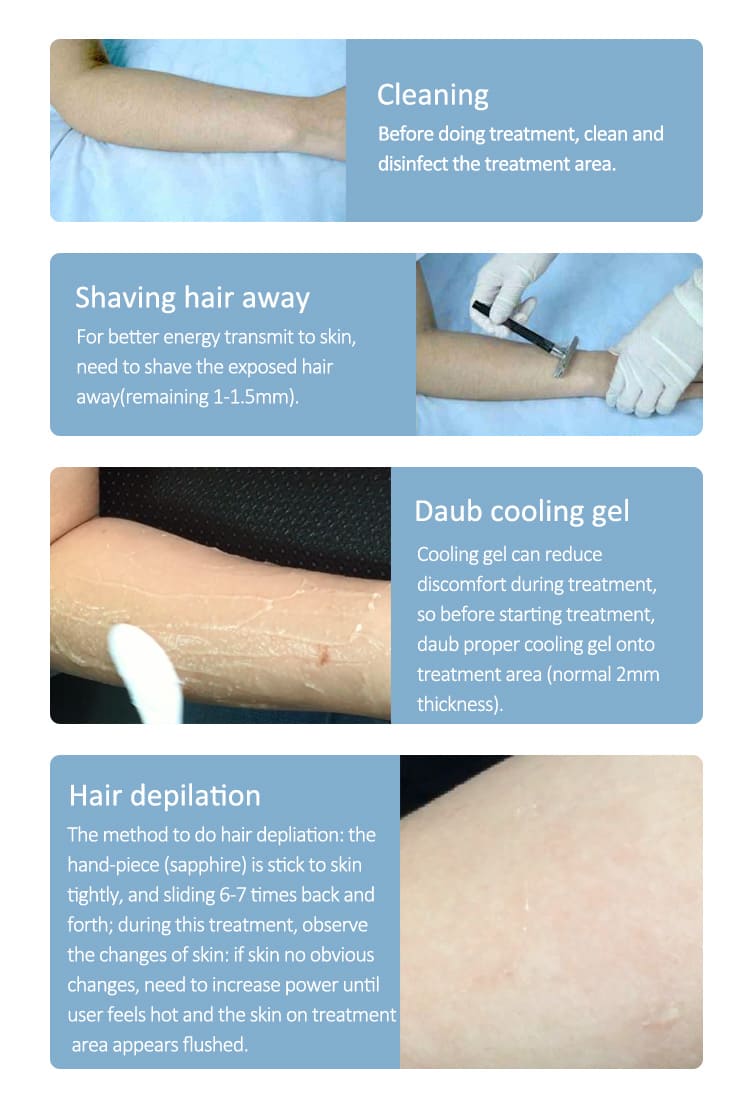 permanent hair removal for women