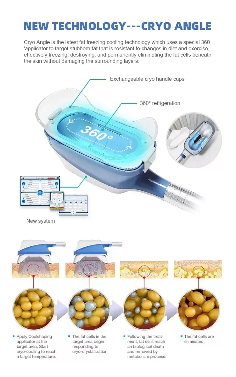 cryolipolysis 3