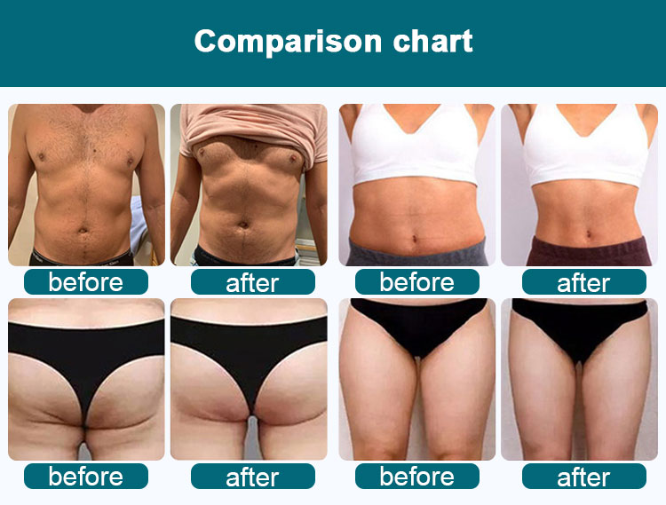 emsculpt neo before and after
