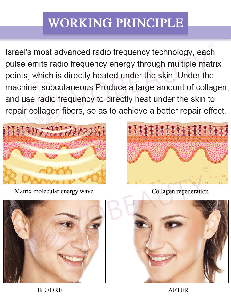 fractional rf machine for home use