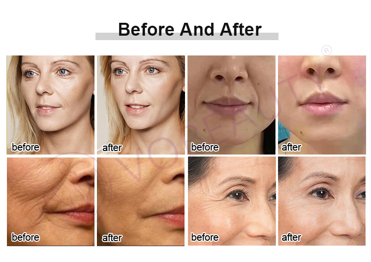rf skin beauty device