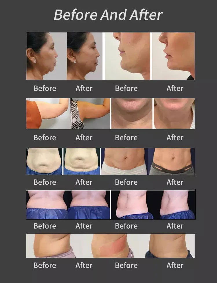 Trusculpt Flex machine