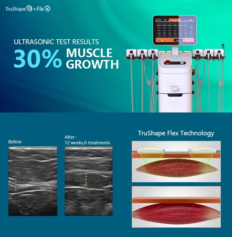 Trusculpt Flex machine