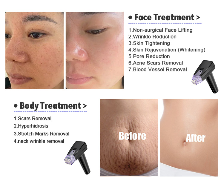 RF Fractional microneedling device