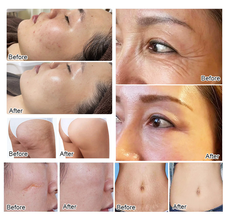 RF Fractional microneedling device