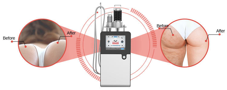 Endospheres therapy machine