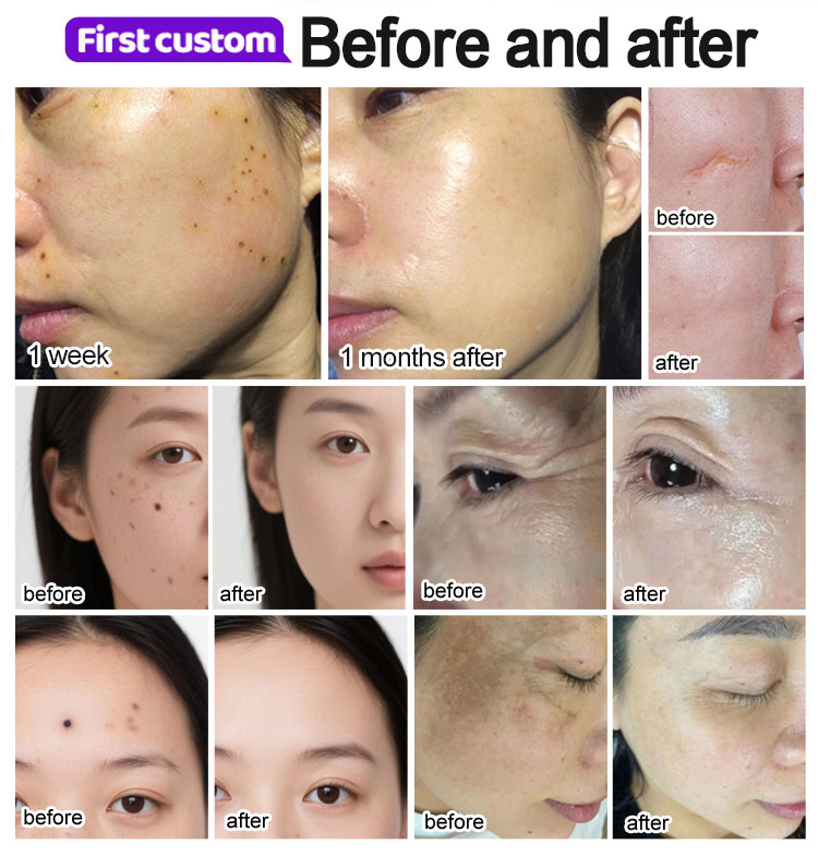 plasma facial skin care device