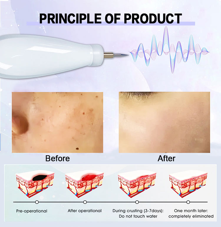 plasma facial skin care device