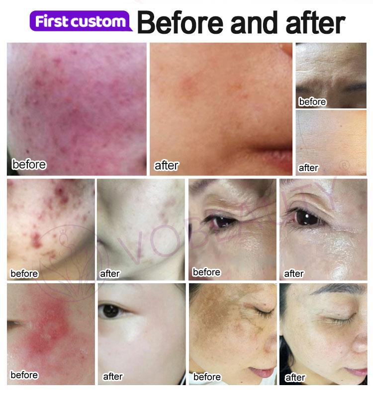 Warm Plasma Jet Skin Rejuvenation